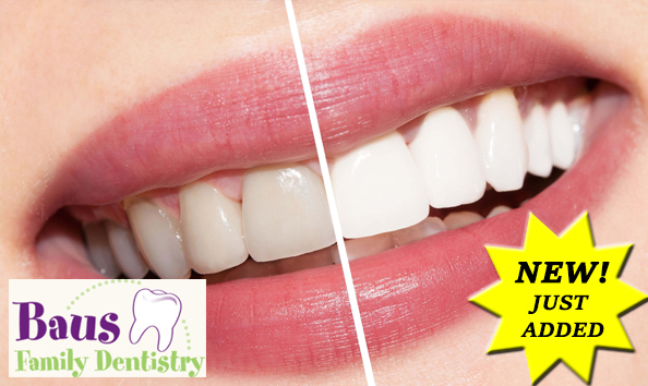Big image teeth whitening