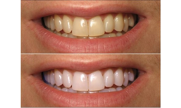 Big image before and after home teeth whitening with coconut oil e1445171893878