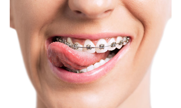 Big image goofy girl with braces