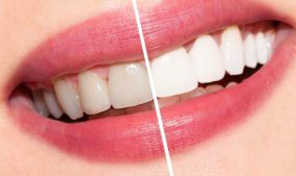 Big image teeth whitening