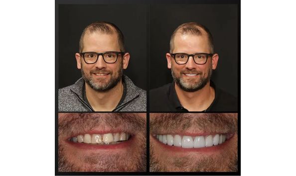 Big image dhteethwhiteningbeforeafter